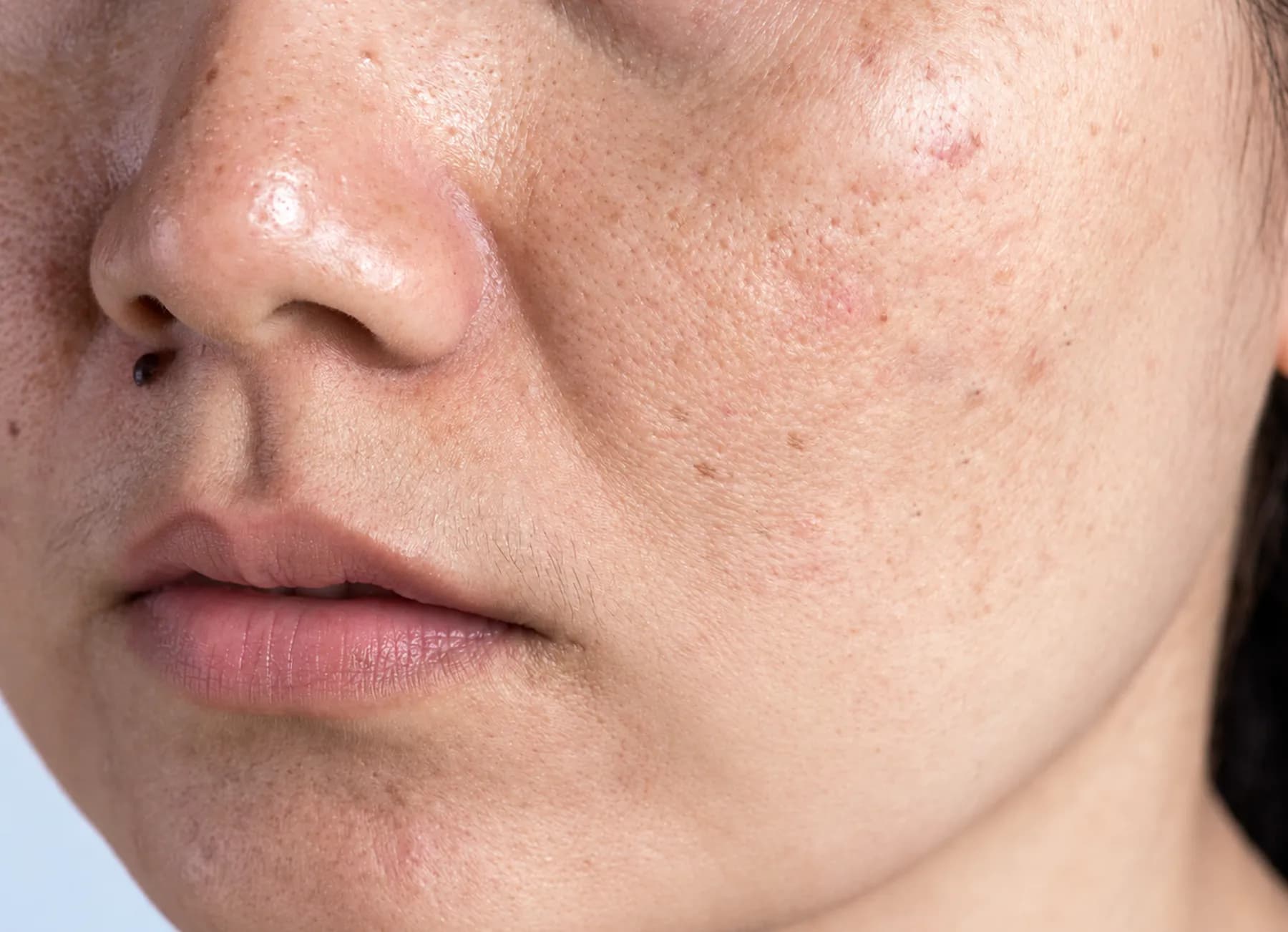 Dull & Uneven Skin Tone