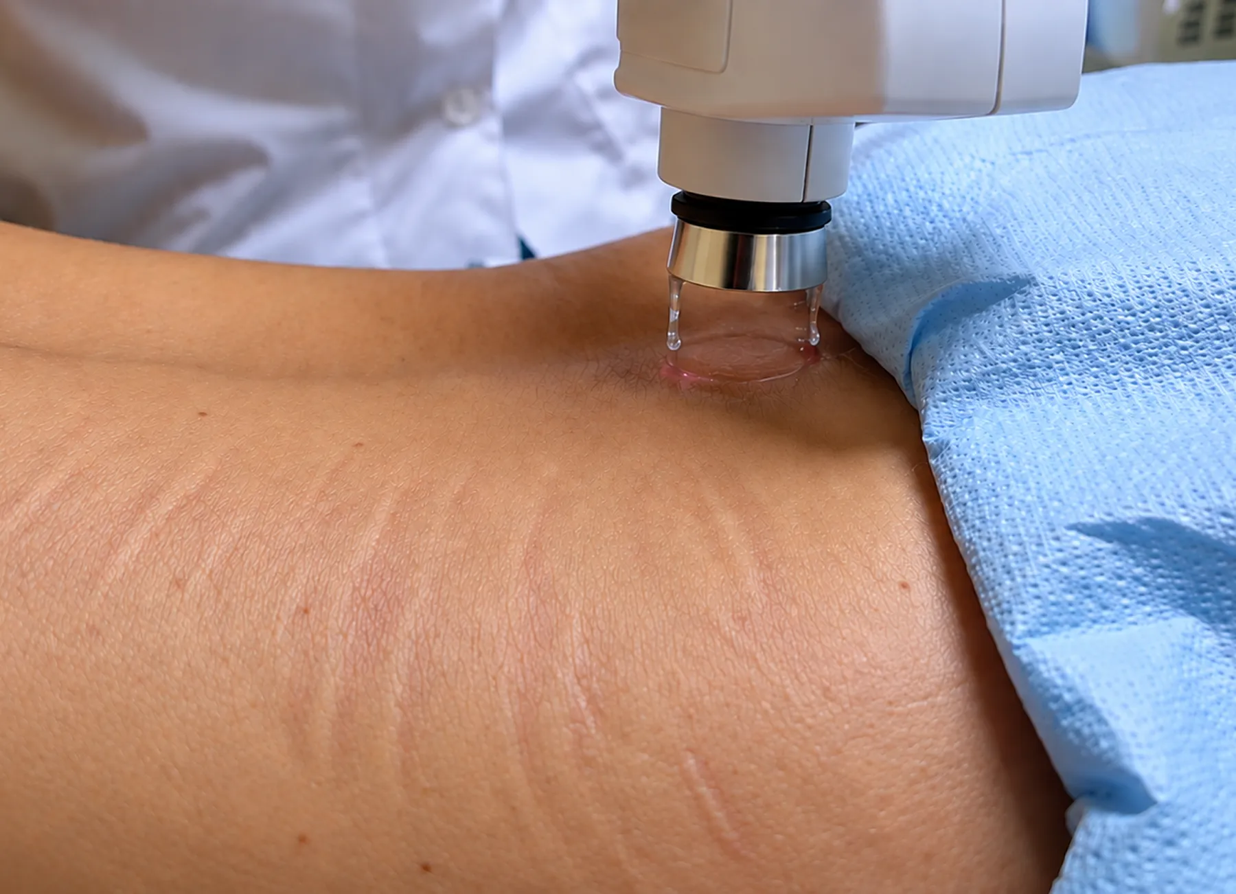 Stretch Mark