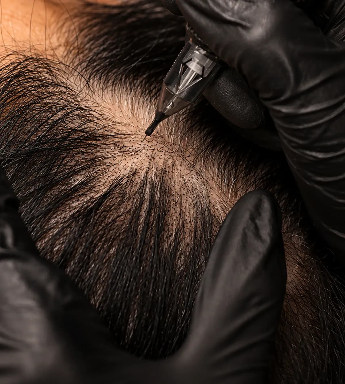 Scalp Micropigmentation