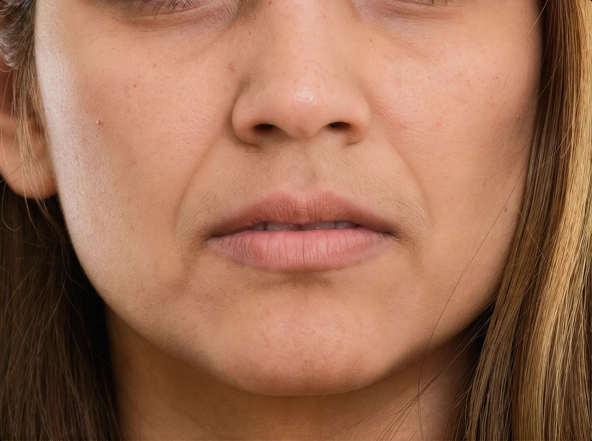 Sculptra, before