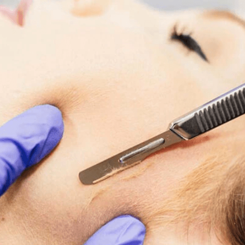 Dermaplaning