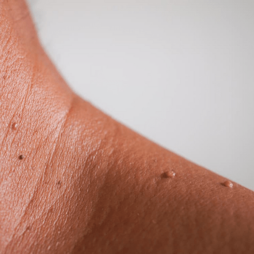 Skin Tag Removal