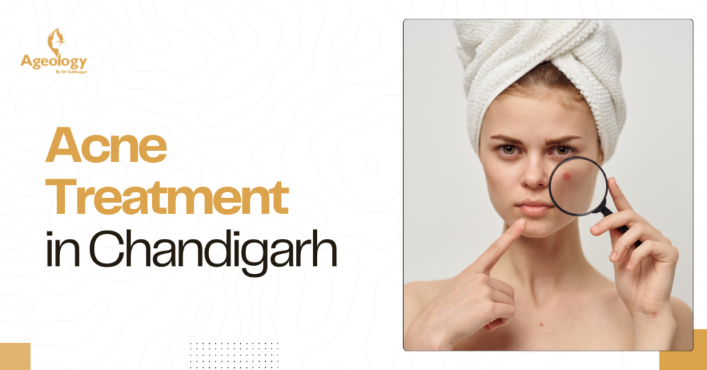 Acne Treatment in Chandigarh