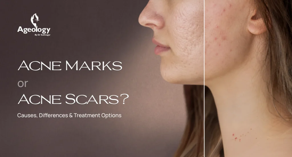 Acne Marks or Acne Scars_ Causes, Differences & Treatment Options